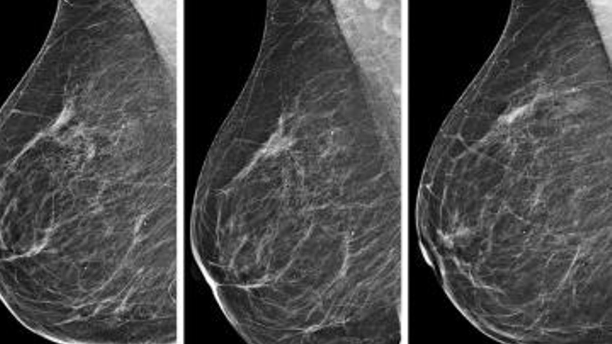 Deep Learning Predicts Cancer Risk from Mammogram Changes - breast cancer risk