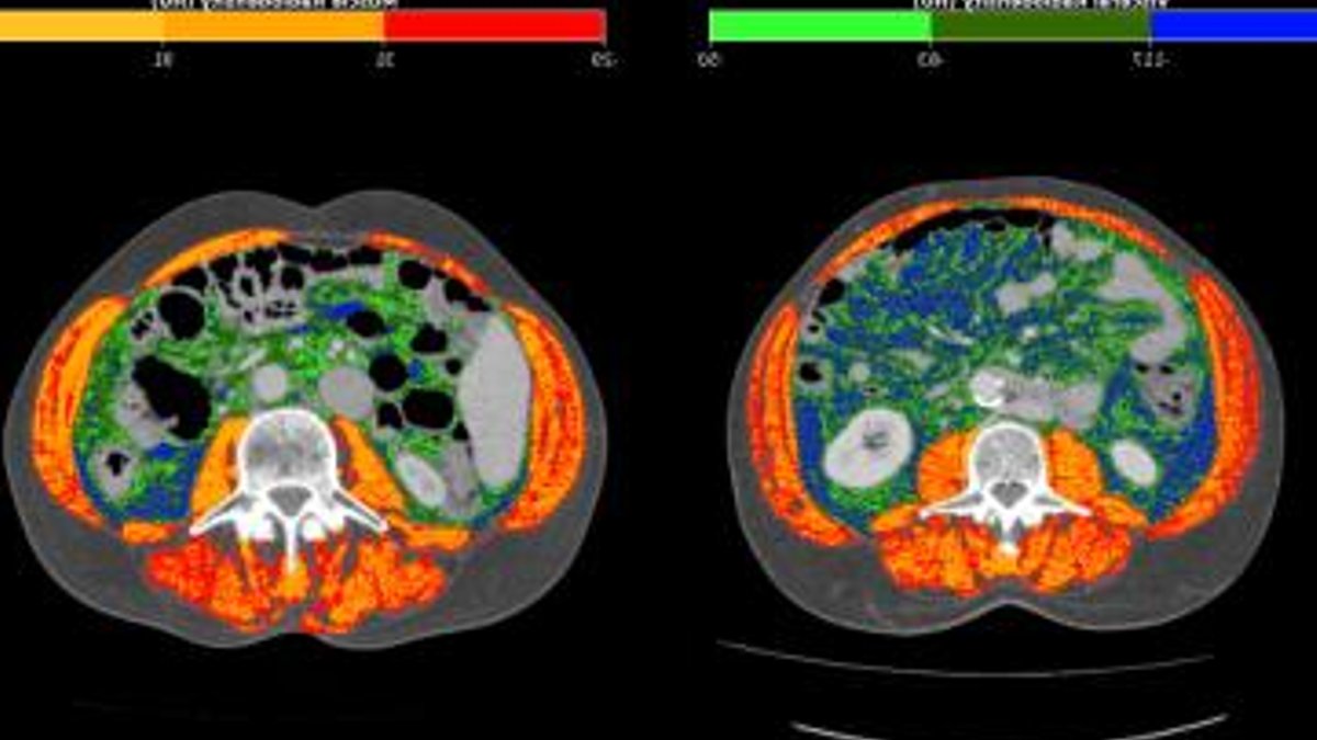 CT scan may improve stomach cancer outlook - stomach cancer