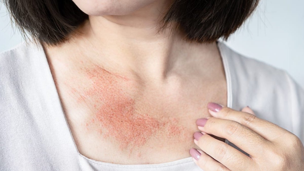 Dermatologists Explain How to Quickly Remove Hives - remove hives