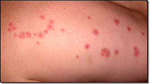 bed bug bites 2