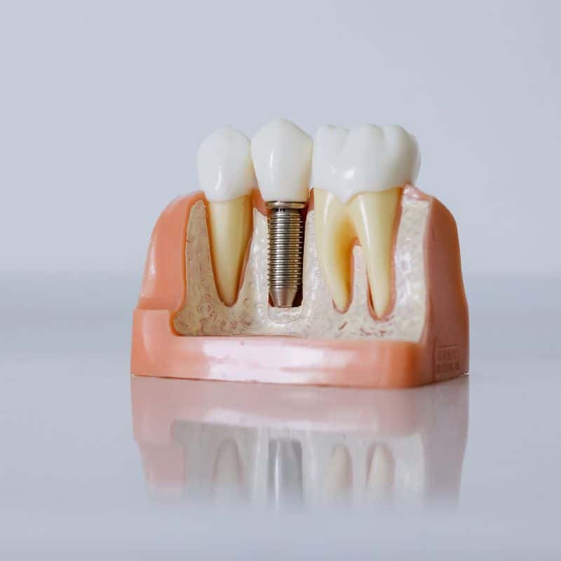 tratamiento implante dental