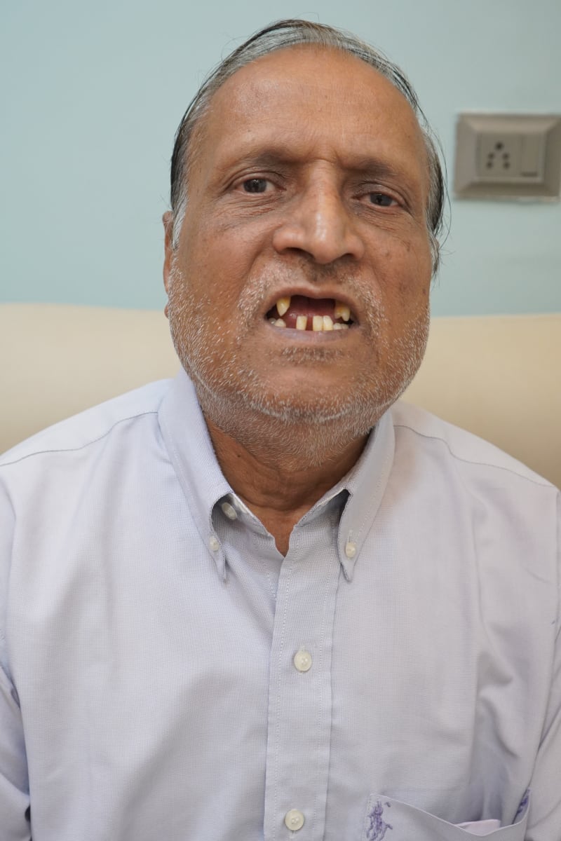 Madanlal Pardesi before Full Mouth Implant in 3 Days