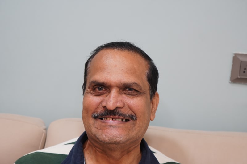 65 year old Pune patient before full mouth dental implants treatment