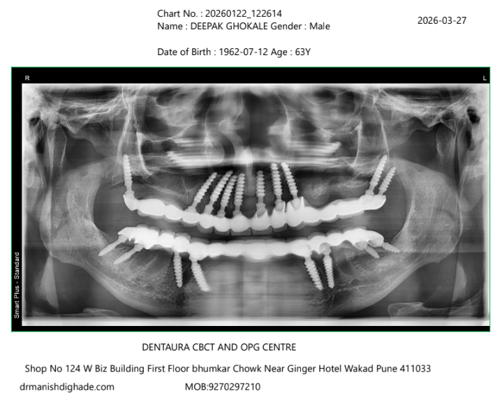 Deepak Gokhale X-ray after treatment