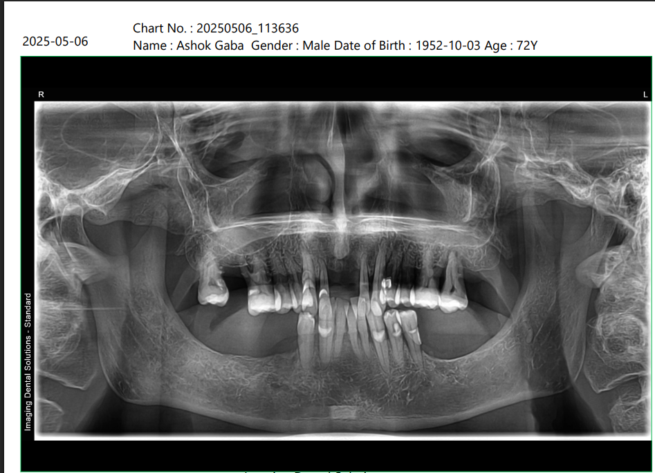 Ashok Gaba X-ray before treatment