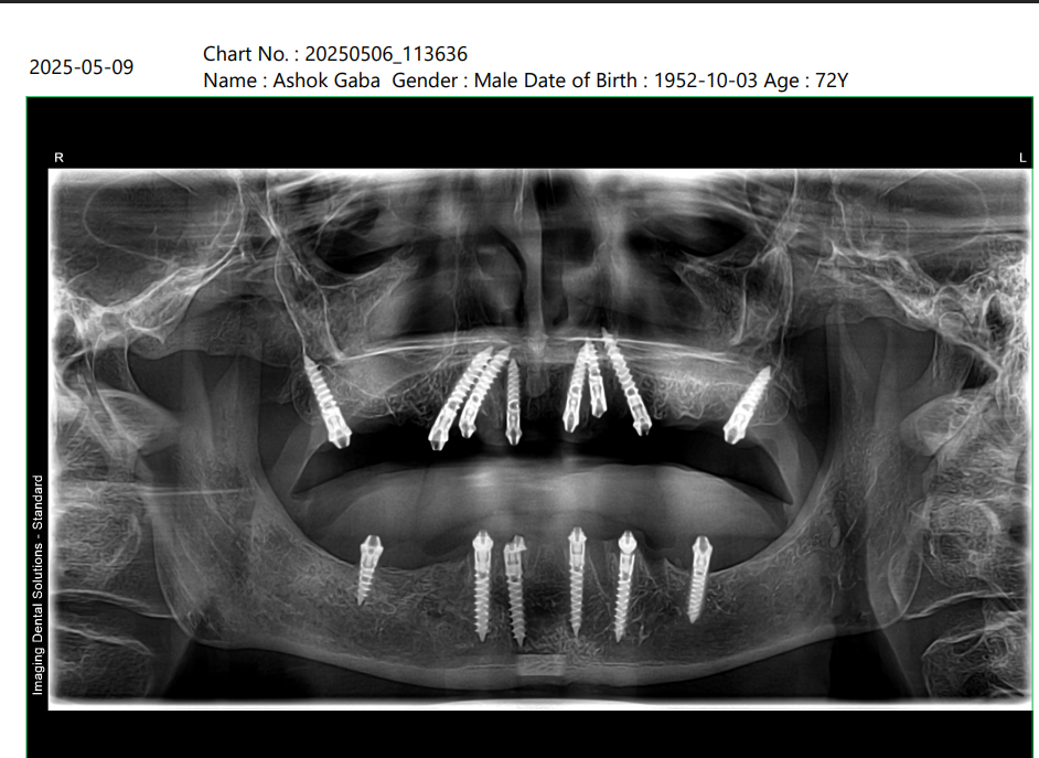 Ashok Gaba X-ray after treatment