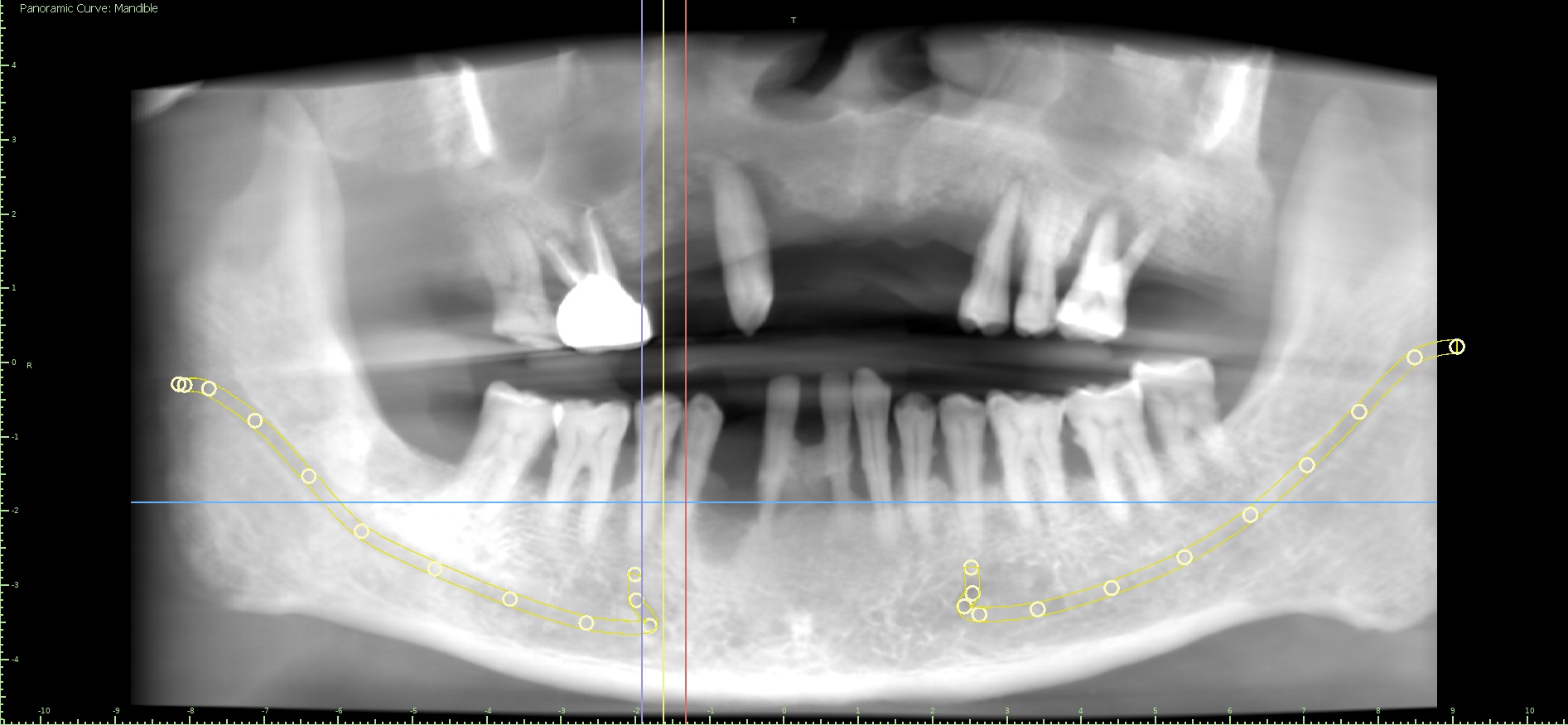 Madanlal Pardesi X-ray before treatment