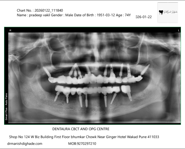 OPG Xray after Dental Implant
