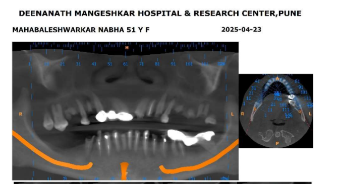 Nabha Mahabaleshwarkar X-ray before treatment
