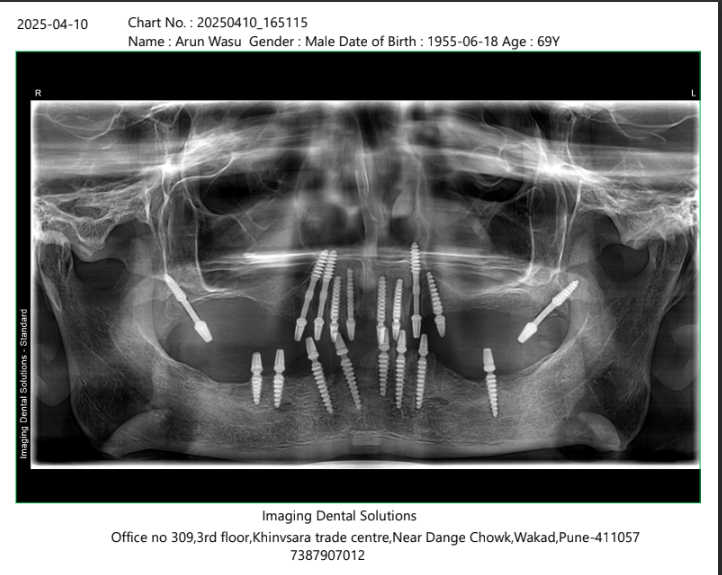 Arun Wasu X-ray after treatment