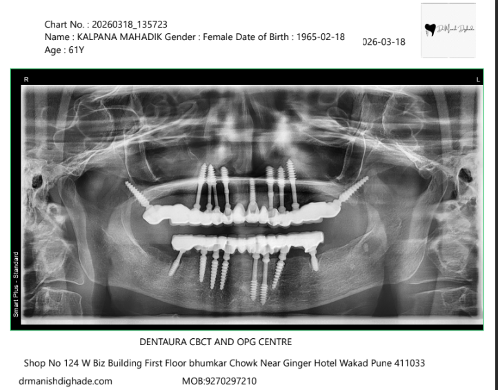 Kalpana Mahadik X-ray before treatment