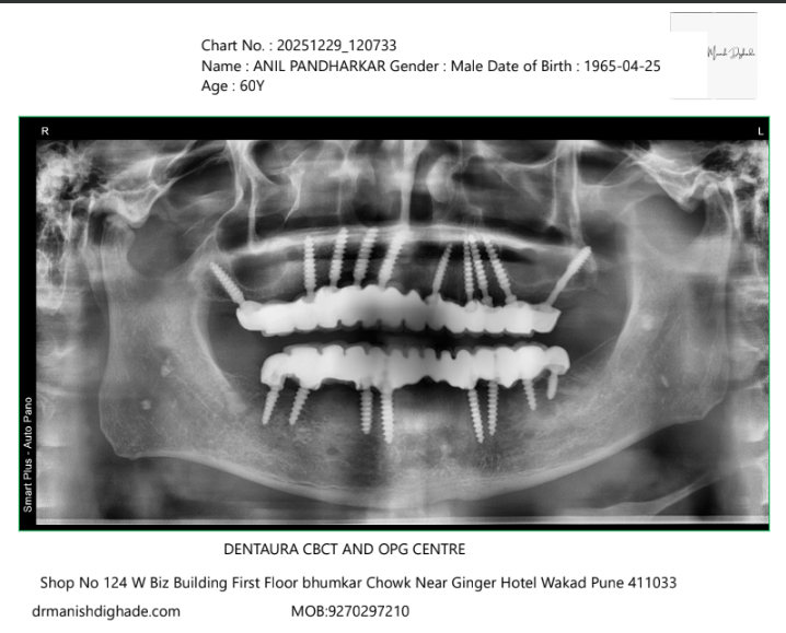 Full mouth dental implants OPG after surgery Pune India”