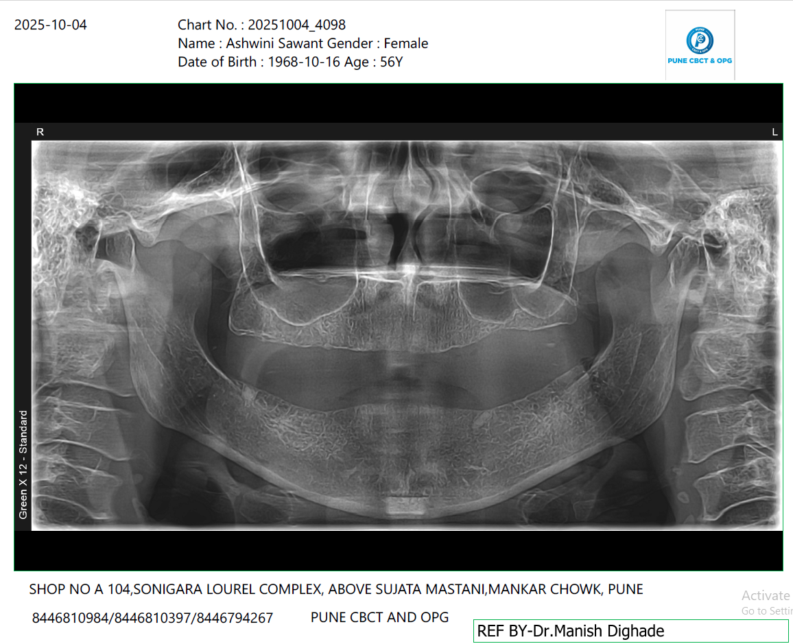 Full mouth implants OPG before treatment India Sindhudurg patient