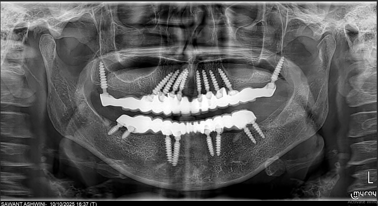 Full mouth implants OPG after treatment India Sindhudurg patient