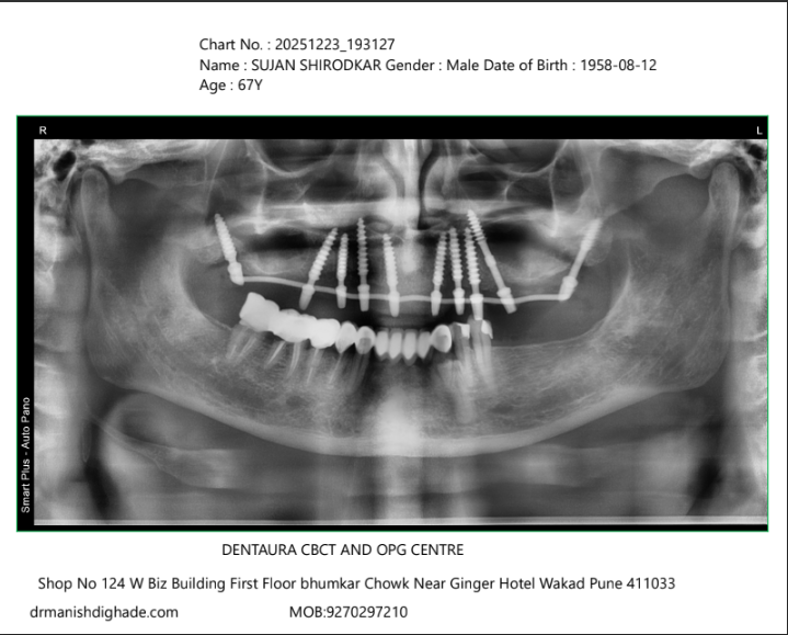 Sujan Shirodkar X-ray after treatment