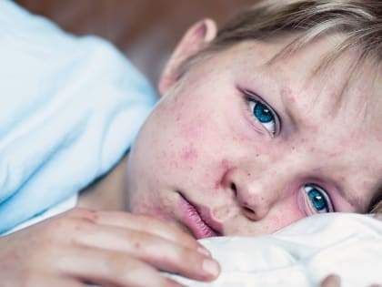 У 23 жителей Ростовской области выявили корь