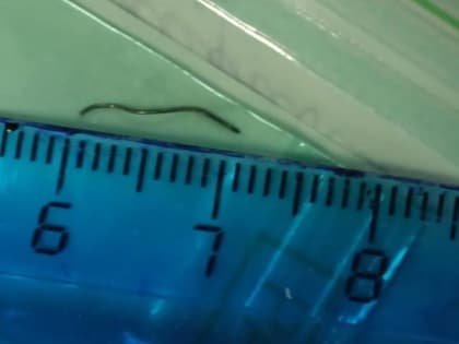 В ГБСМП Ростова спасли мужчину, который чуть не лишился зрения из-за металлической щетины