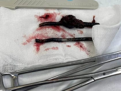 Ростовчанин на спор проглотил два гвоздя