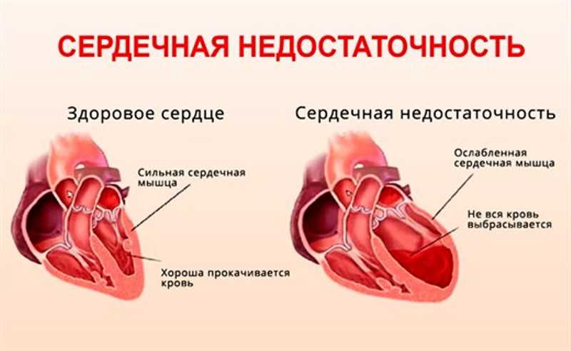 Сердечная недостаточность результат