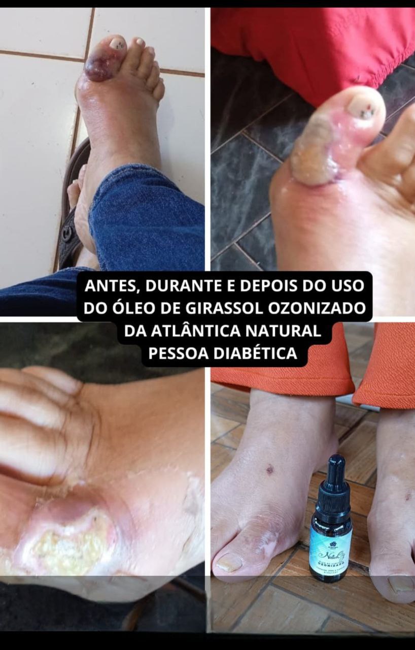 Pé Diabético