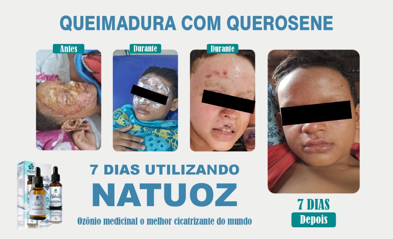 Antes e Depois Queimadura