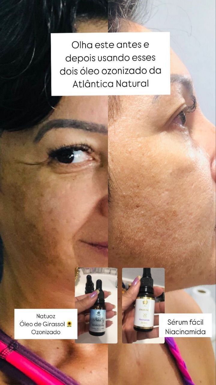 Resultados Melasma