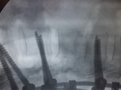 Красноярке после катания на «плюшке» пришлось винтами закреплять позвоночник