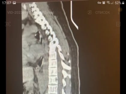 Клинический случай. Травма после катания на тюбинге.