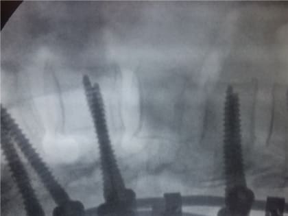 Красноярка получила травму позвоночника во время катания на тюбинге