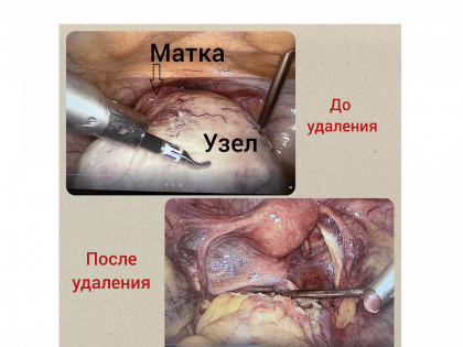 Врачи КГБУЗ «КМКБ № 4» спасли женщину, удалив редкую разновидность миомы матки/