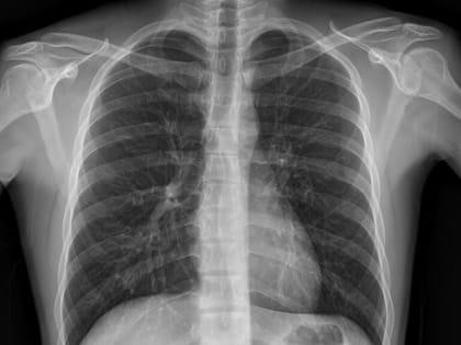 План обследования на туберкулез на 2023 год