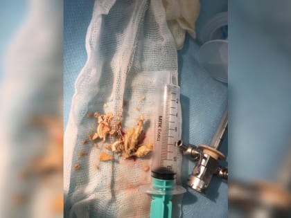 Врачи-урологи КГБУЗ «КМКБ № 4» удалили пациентке камень из мочевого пузыря, ядром которого была гинекологическая спираль.