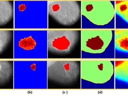 Учёные разработали систему для обнаружения границ опухоли молочной железы