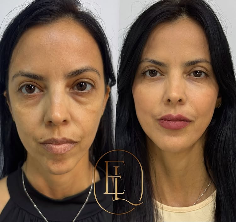 Antes e depois - harmonização facial