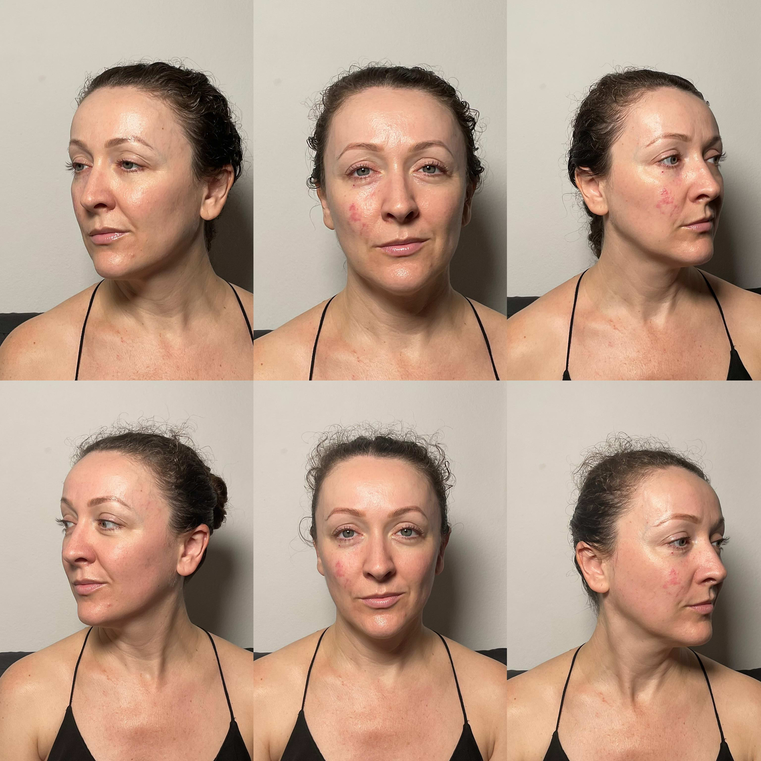 Erion Beauty treatment results - before and after craniofacial massage