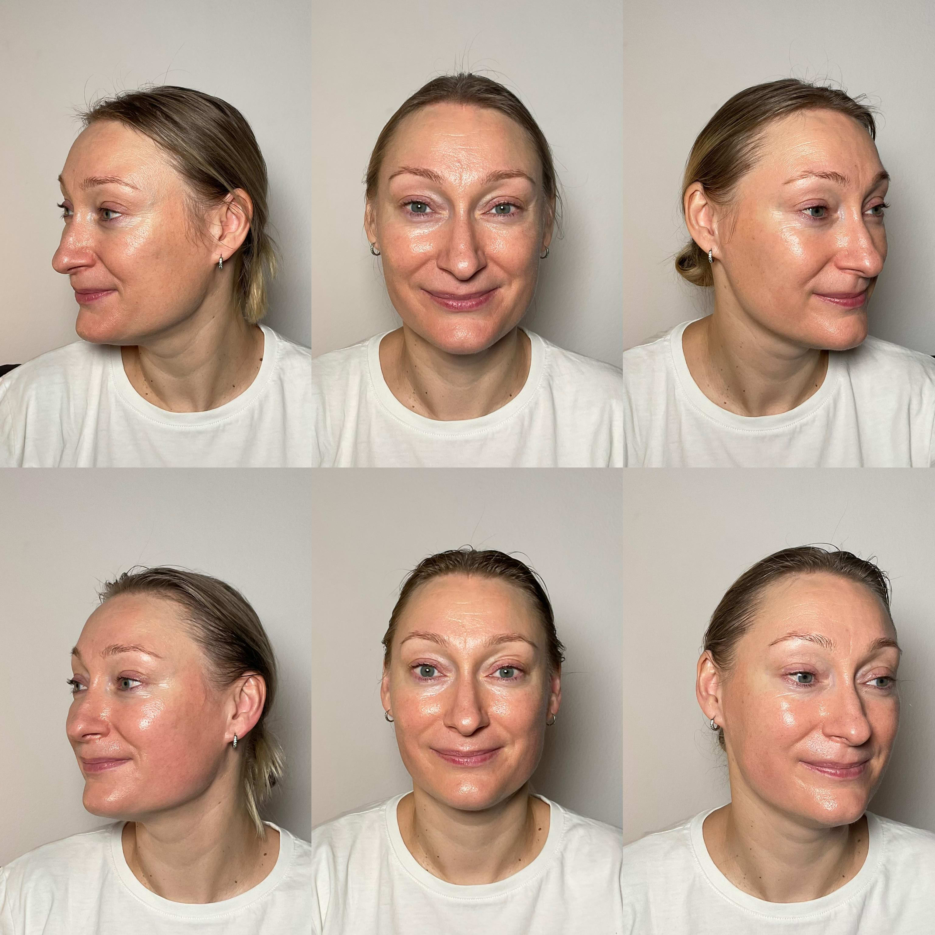 Erion Beauty treatment results - before and after facial harmony treatment