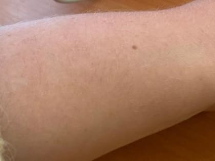 В Сатке началась неделя бесплатной проверки новообразований кожи