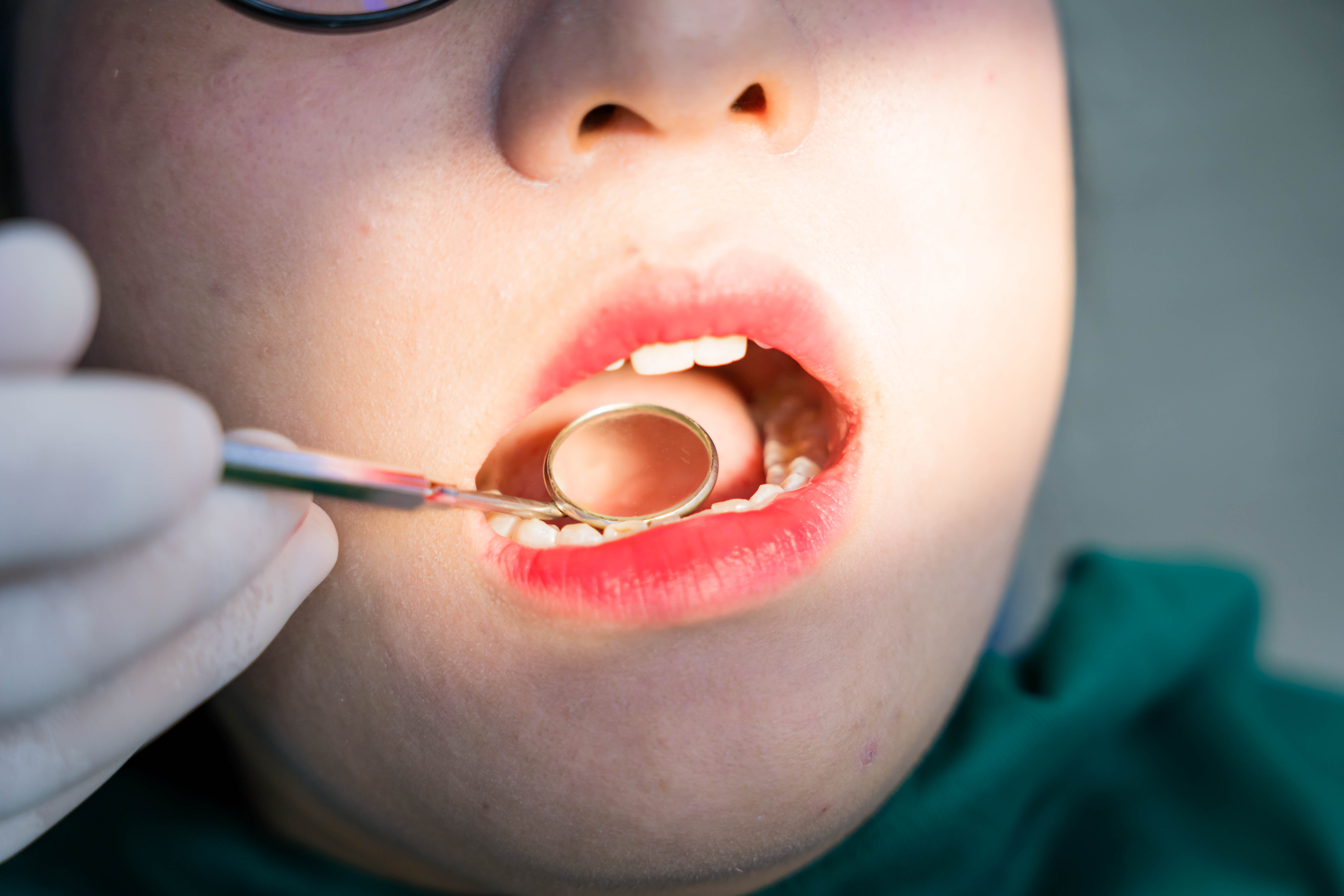 Mất một răng nên trồng Implant hay làm cầu răng?