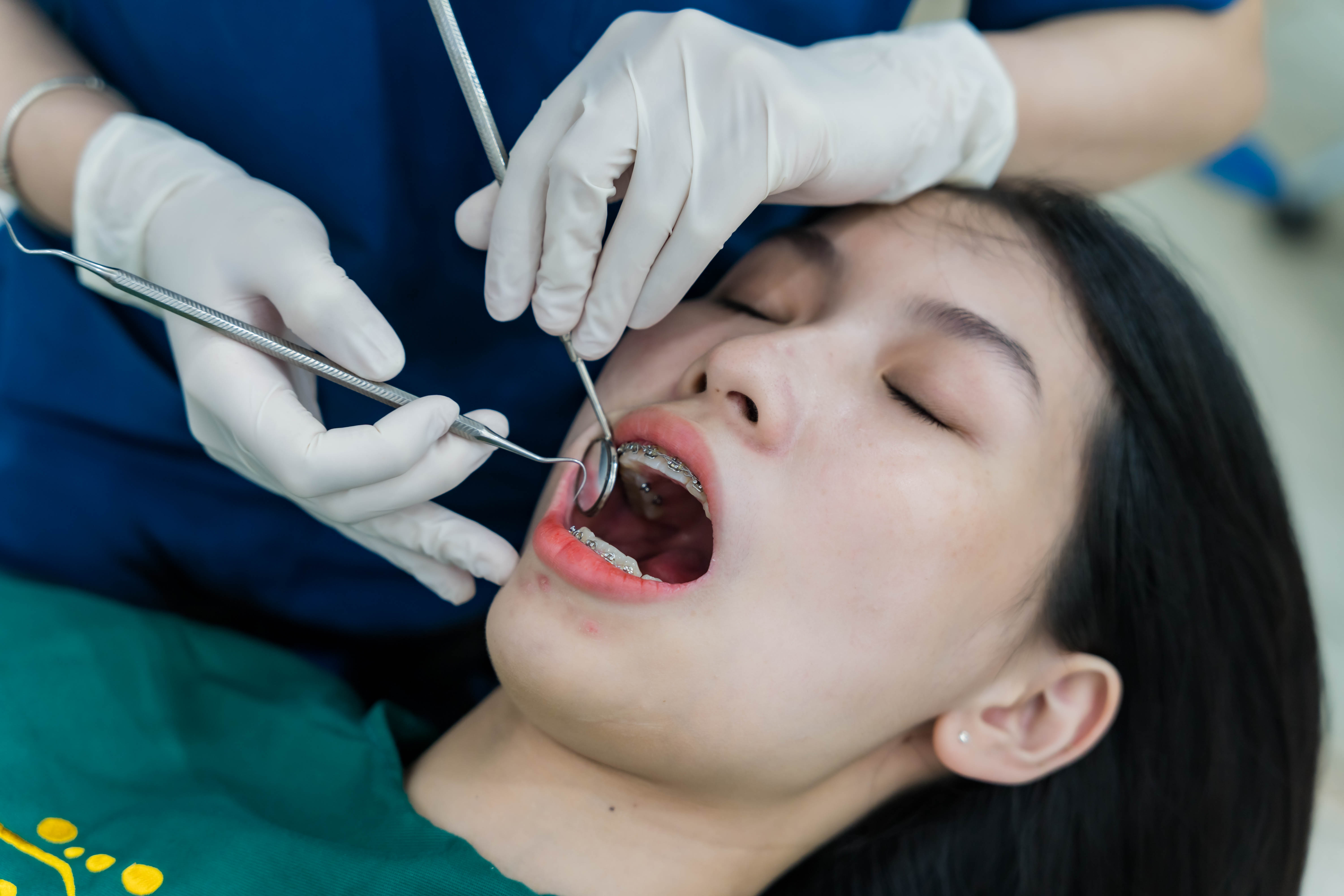 Niềng răng chỉnh nha tại Nha Khoa Mễ Trì