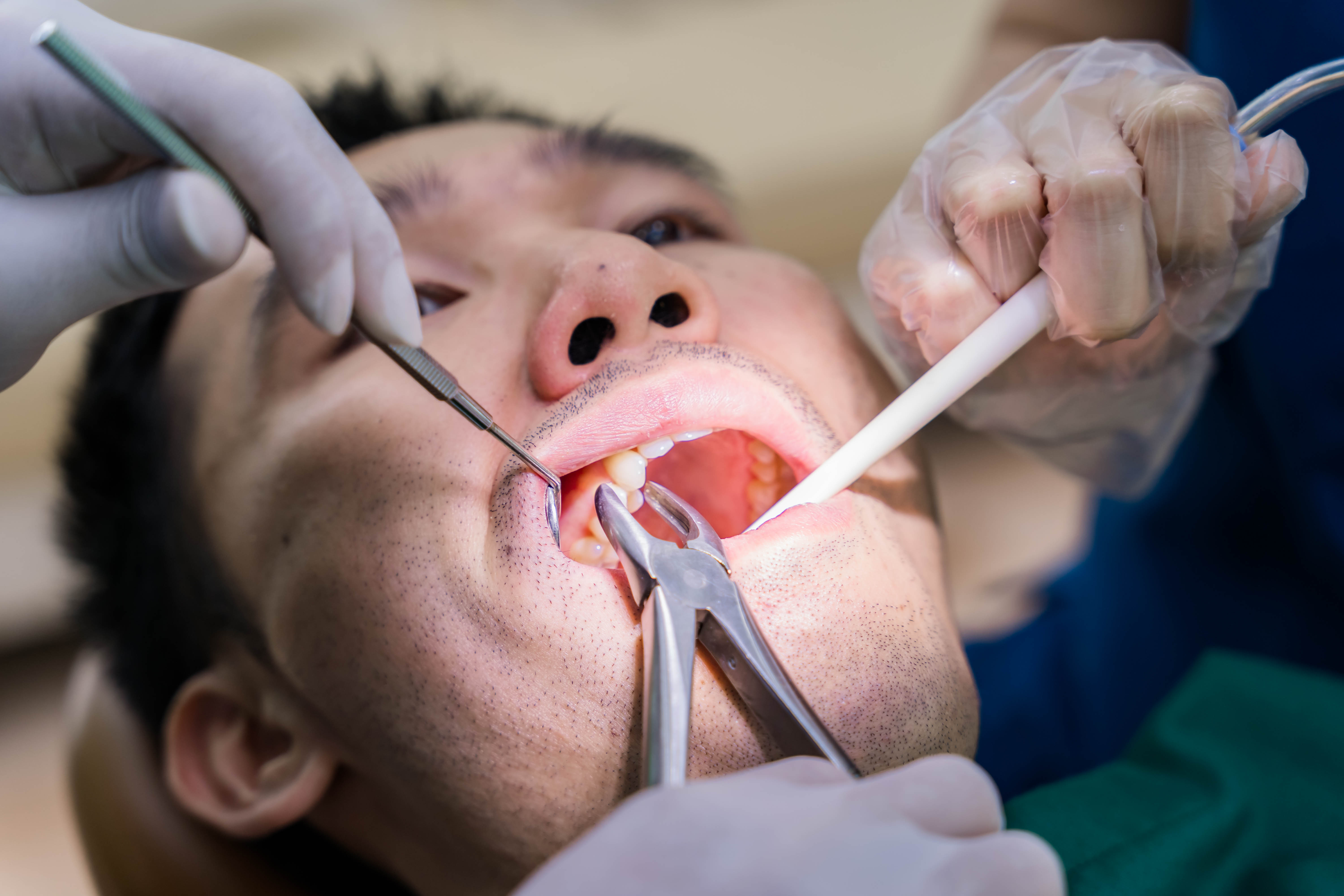 美池牙科诊所 的 拔牙