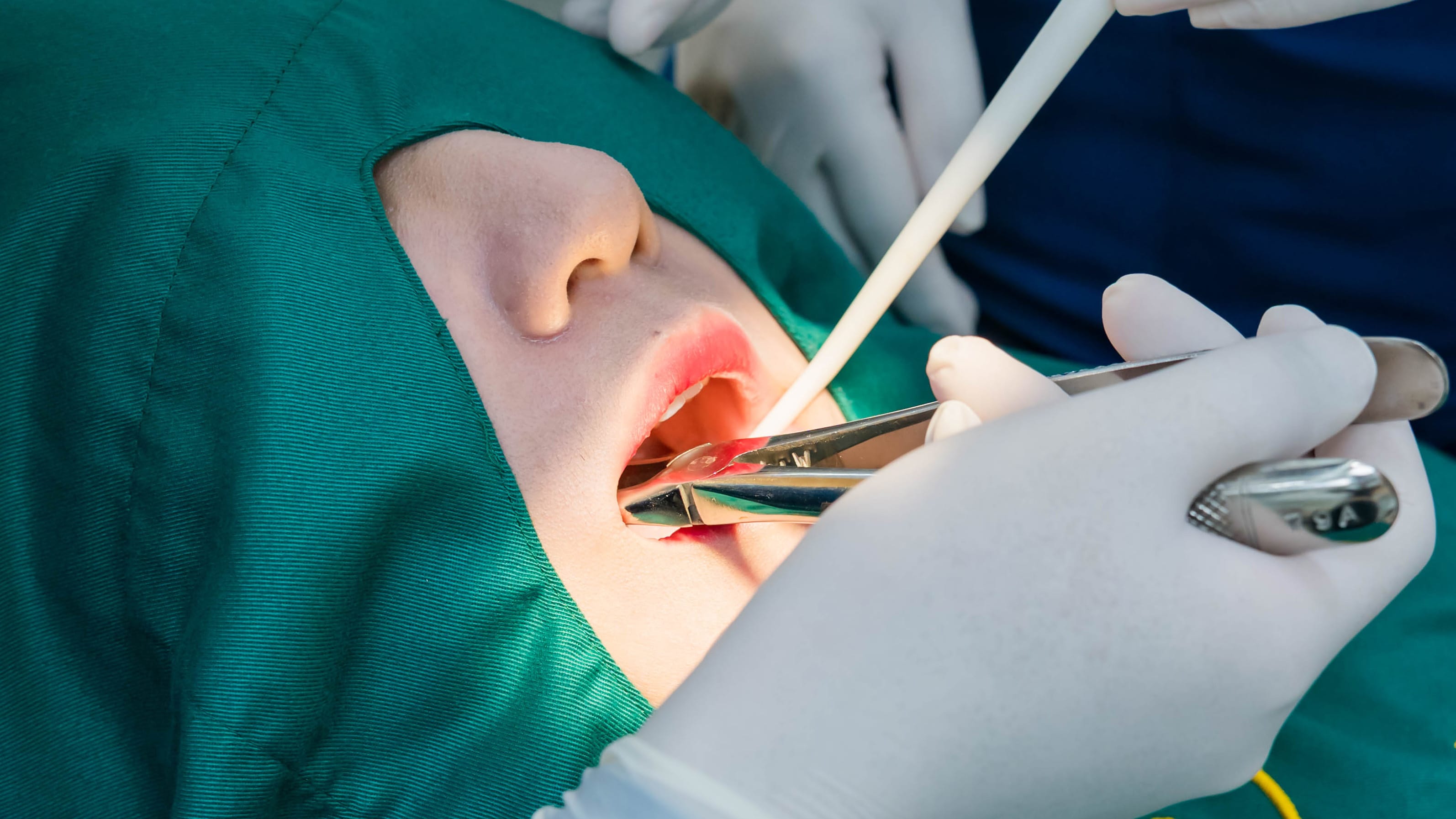 美池牙科诊所 的 拔智齿