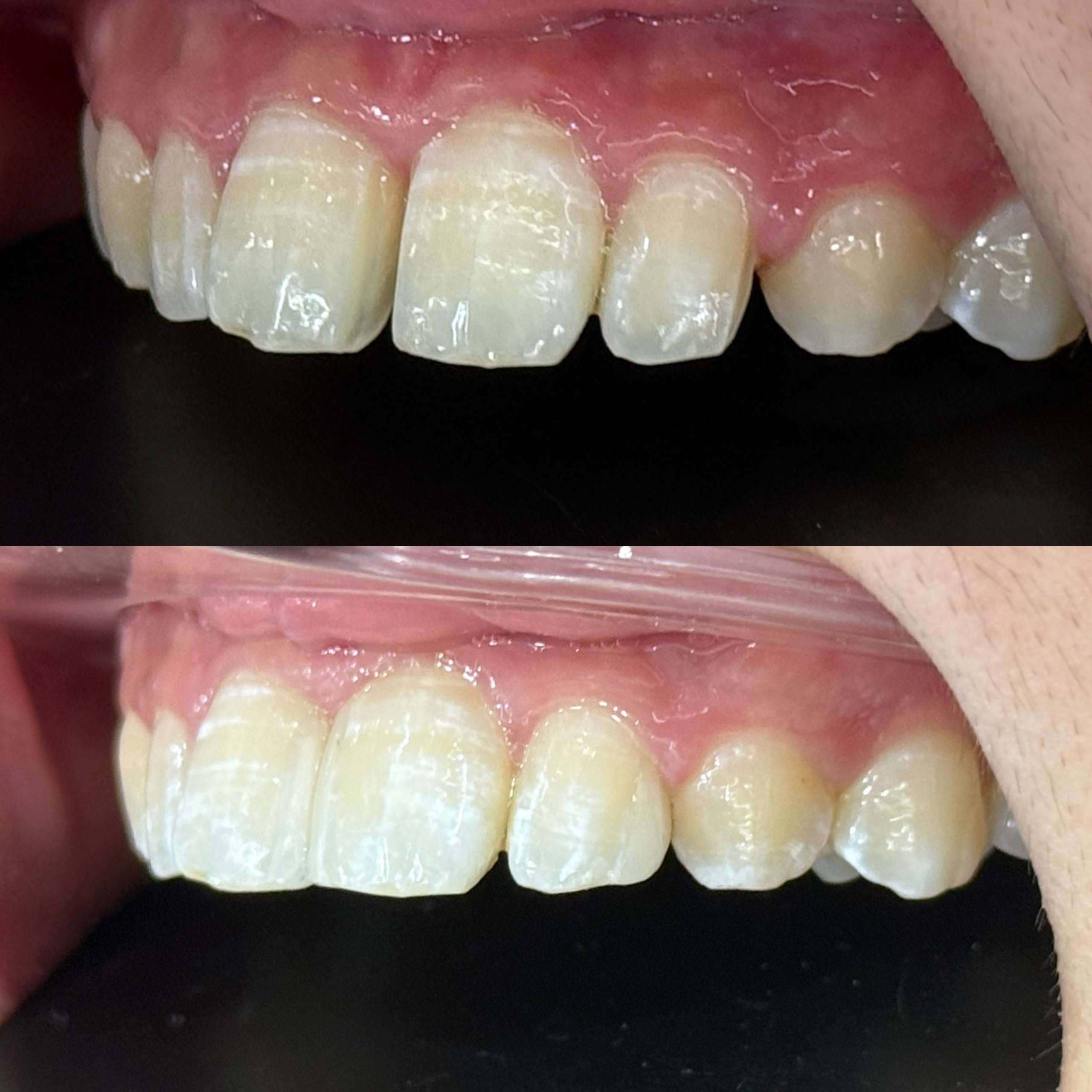 Chip Veneers tại Nha Khoa Mễ Trì