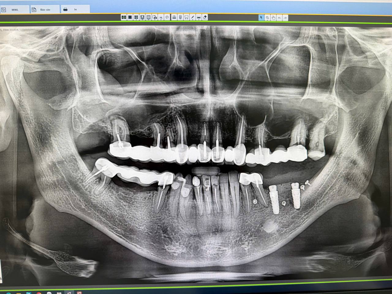 Chi phí trồng răng Implant tại Hà Nội: Bảng giá trọn gói và chi phí có thể phát sinh