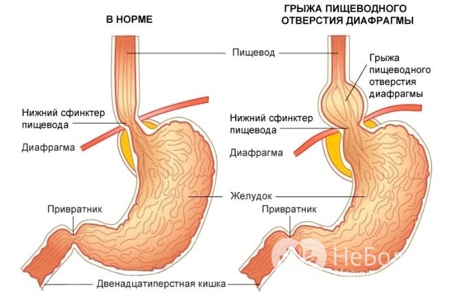 что грыжа пищевода лечение диета Вами согласен. Идея