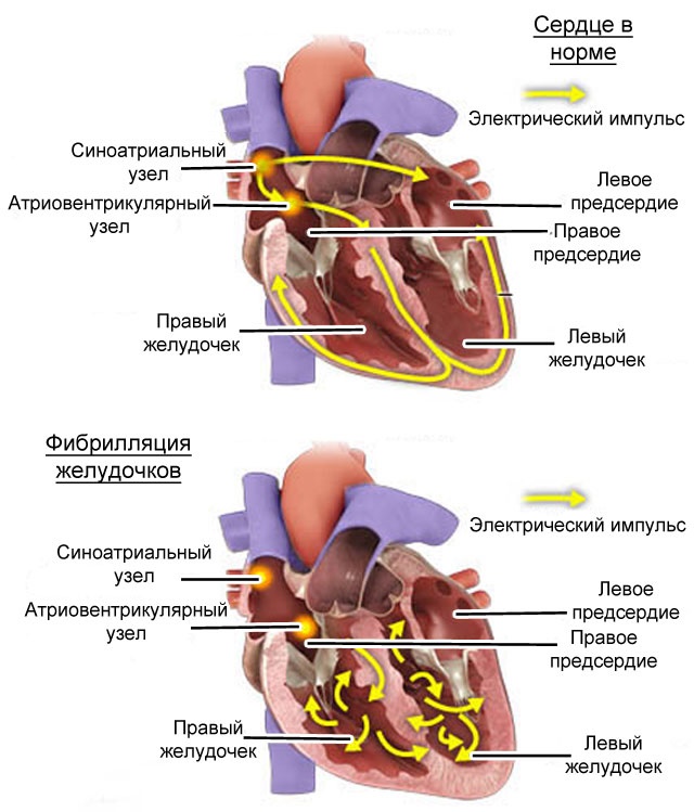 Перебои в сердце. Фибрилляция желудочков патогенез. Фибрилляция желудочков механизм развития. Фибрилляция желудочков кардиогенный ШОК. Трепетание желудочков патогенез.