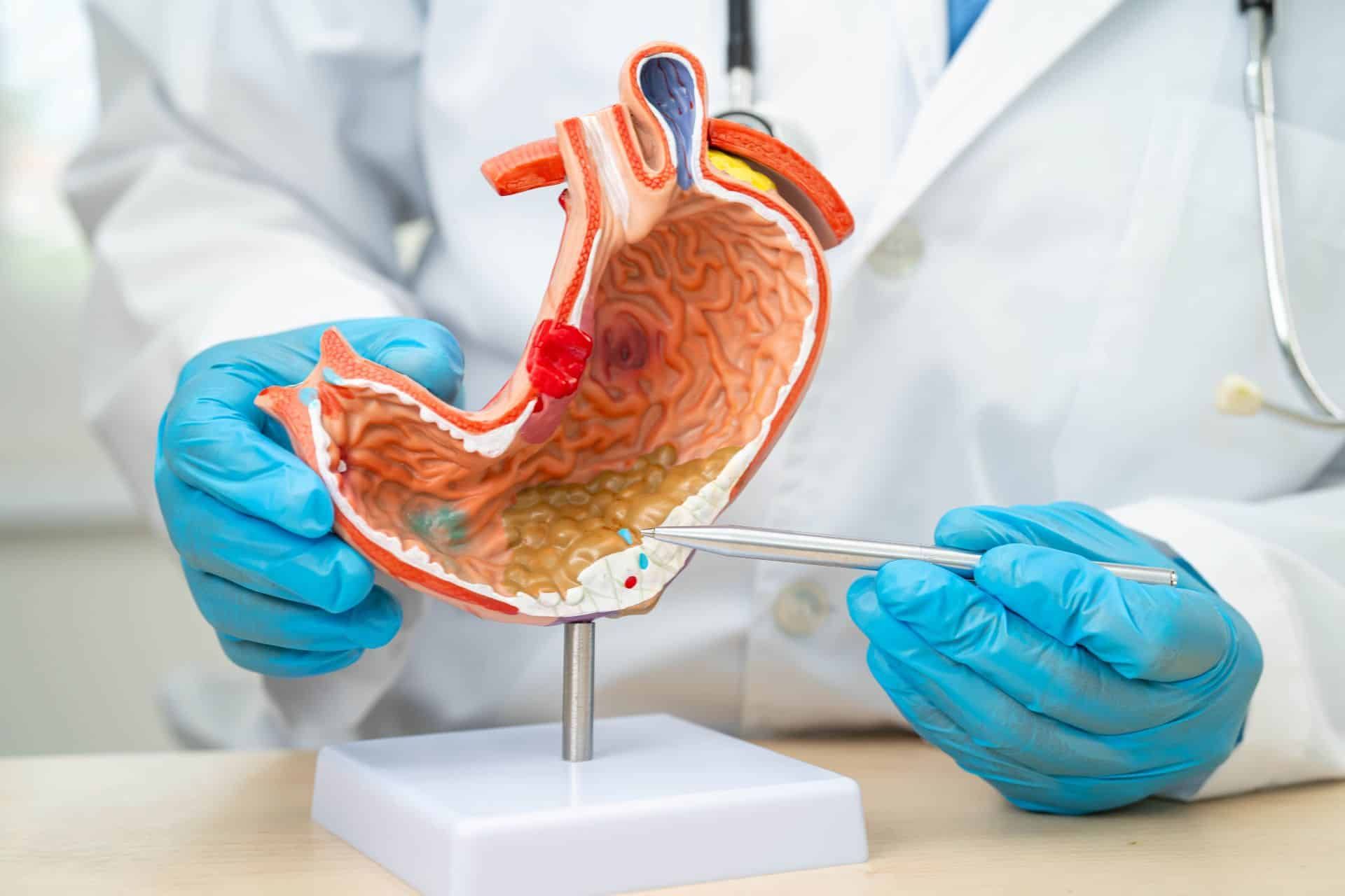 гастроскопія рак шлунка