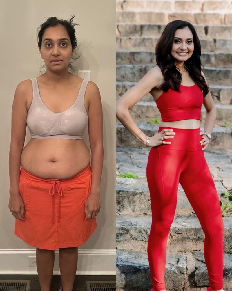 Dr. Rachna Bhikka before and after