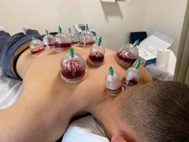 Wet Cupping (Hijama) Therapy in Ranchi | Natural Healing & Wellness