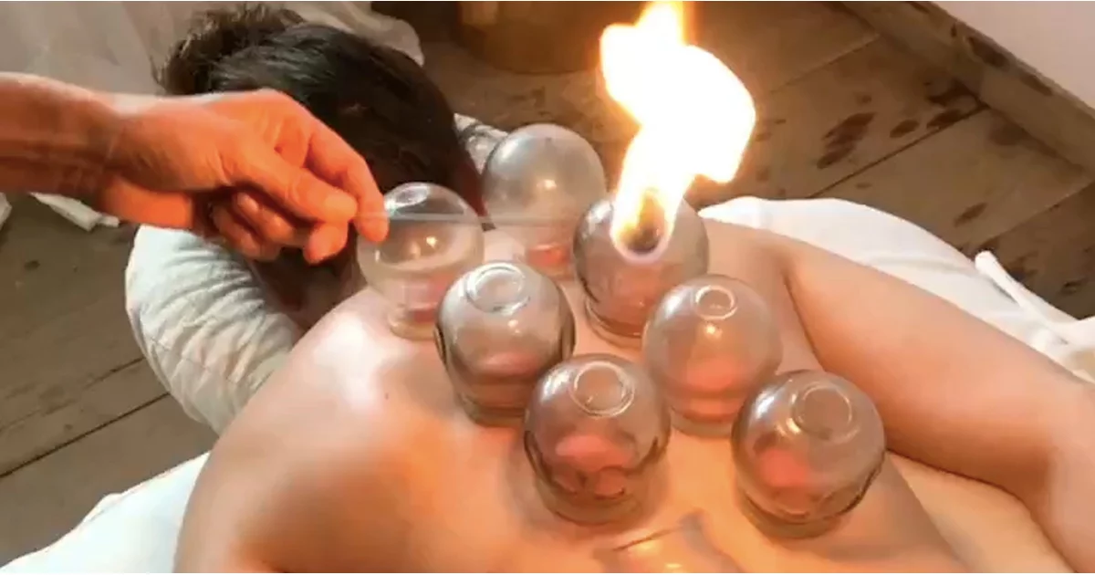 Fire Cupping Therapy: Benefits, Process, and Why Choose Twin Brothers Therapy in Ranchi