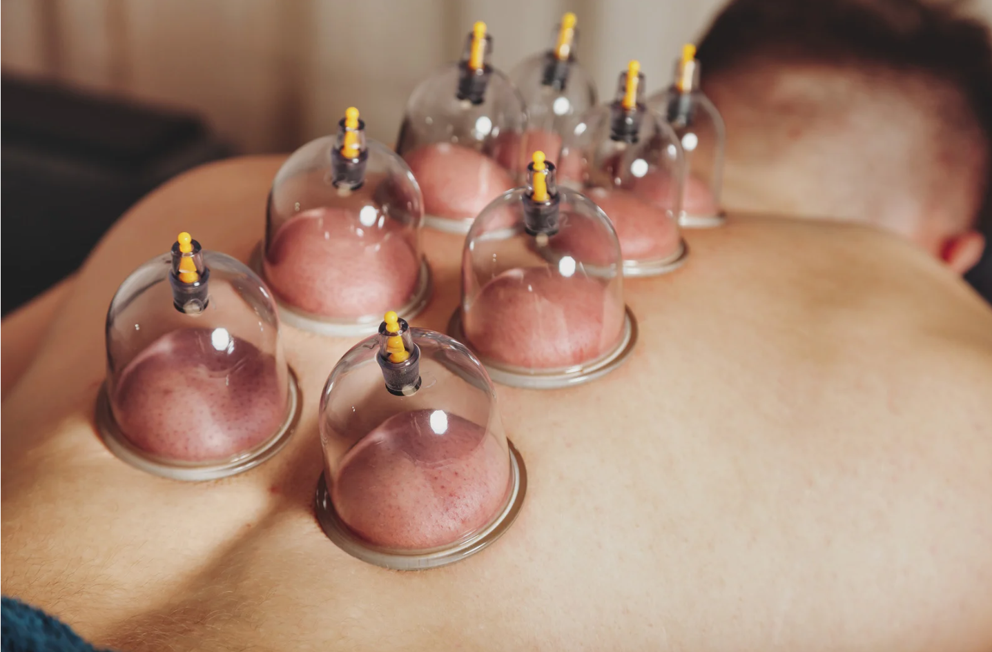 Dry Cupping Therapy in Ranchi – Natural Pain Relief and Muscle Recovery at Twin Brothers Therapy